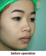 plastic_surgery_augmentation_rhinoplasty